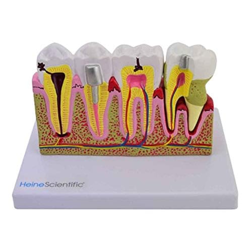 HeineScientific Modell der Zahnschäden und -erkankungen, 2-teilig