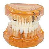 Zahnmodell - 1pc Orange Farbe Zahnkrankheit Abnehmbare Studie Lehre Zähne Modell