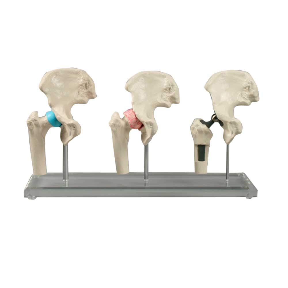 Erler Zimmer Hüft-Implantat-Modelle Anatomie Modell Hüftmodell verkleinert, gesund/krank/Implantat, 3St