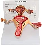 Bildungsmodell anatomisches Modell des weiblichen Uterus - anatomisches Modell der Ovarian Läsion pathologischer inneren Geschlechtsorgane zu medizinischen Ausbildung gynäkologischen
