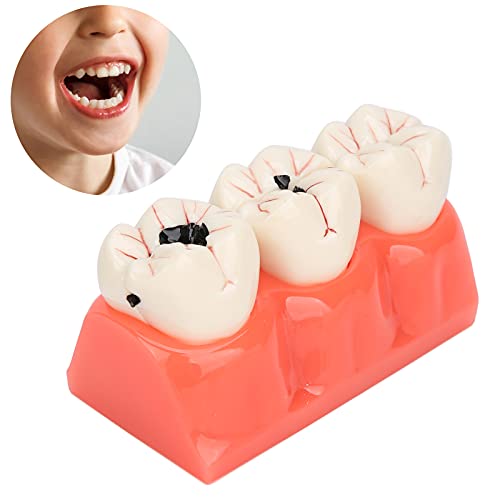 Zahnkaries-Modell, einfach zu tragen, bequem zu bedienendes Simulations-Zahnkaries-Modell für zu Hause für die Familie