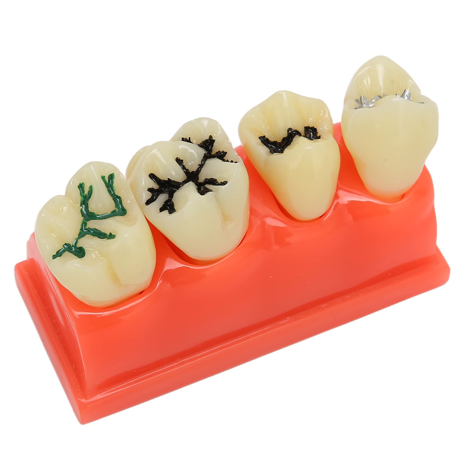 Modell für verfallene Zähne, Mundpflege-Lernmodell für Zahnkaries, lehrreich für Zahnkliniken zur Demonstration