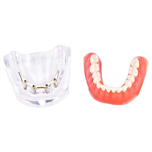 Zahnmodell, Dental Implant Zähne Modell Standard Dental Lehrstudie Demonstration Tool, 7 x 5,5 cm