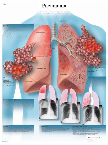 3B Scientific Humananatomie – Lungenentzündung, laminierte Version