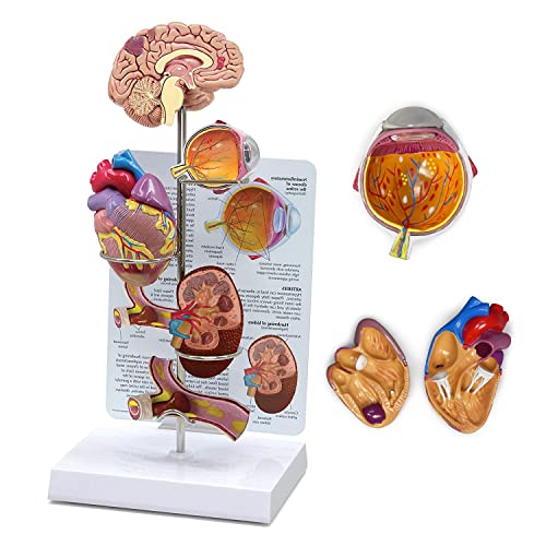 Bluthochdruck-Modell Miniatur-Gehirn-, Augen-, Herz-, Nieren- Und Arterienmodelle Set Körperanatomie-Nachbildung Bluthochdruck-Modell Für Lehrmittel