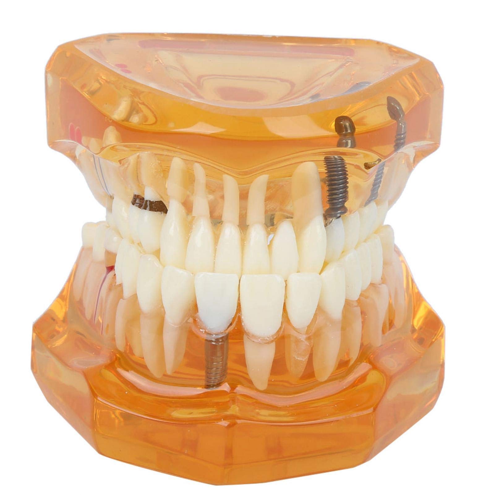 Zahnmodell - 1pc Orange Farbe Zahnkrankheit Abnehmbare Studie Lehre Zähne Modell