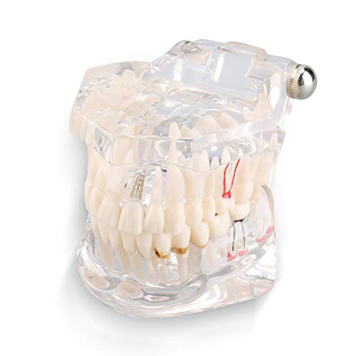 Zahnmodell, zahnärztlich entfernbarer Zahn Lehrpraxismodell für Lehren, Üben und Lernen, transparentes Zahnimplantat-Zahnmodell