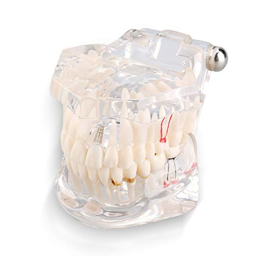 Jadeshay Zahn Modell - Zahnerkrankungen - Lehrstudie für Erwachsene Typodont Demonstrationszähne Neu