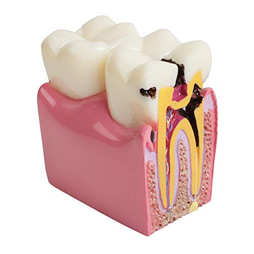 Zahnersatz Modell Zahnkaries Zahnmodell Patientenbildung Zahnmodell 6 Mal Karies Vergleichsstudie