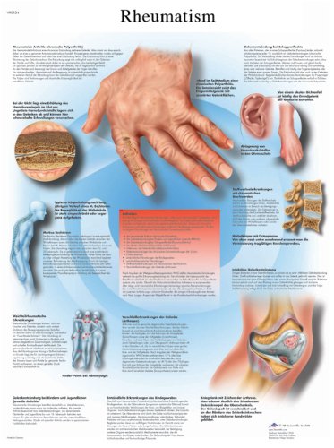 3B Scientific Human Anatomy - Rheumatische Erkrankungen, laminierte Version