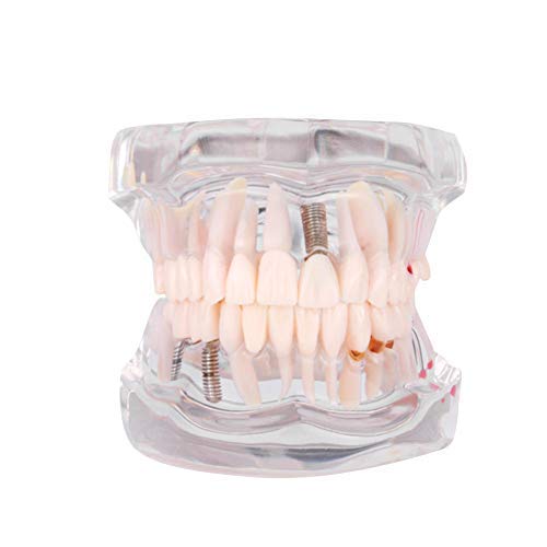 Jadpes Zahnmodell, Modell für abnehmbare Zähne, Modell für Erwachsene Typodont-Demonstrationszähne, Modell für die Lehre von Zahnkrankheiten Neu
