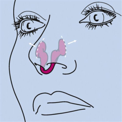 Airmax Schnarch-Hilfe, Erweiterung der Nasenöffnung