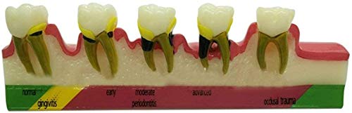 LBYLYH Dental Zähne Modell, Parodontose Parodontose Klassifizierung Modell Zähne Studie Lehre Modell Adult Standard-Demonstration Zahnmodell