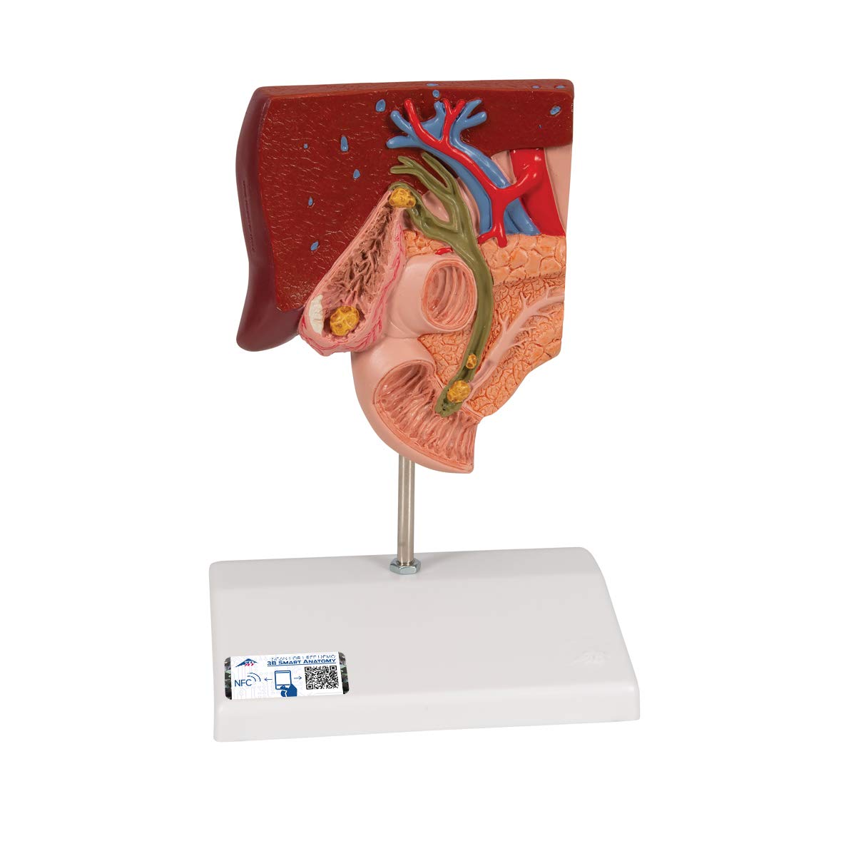 3B Scientific Menschliche Anatomie - Gallensteinmodell + kostenlose Anatomie App - 3B Smart Anatomy