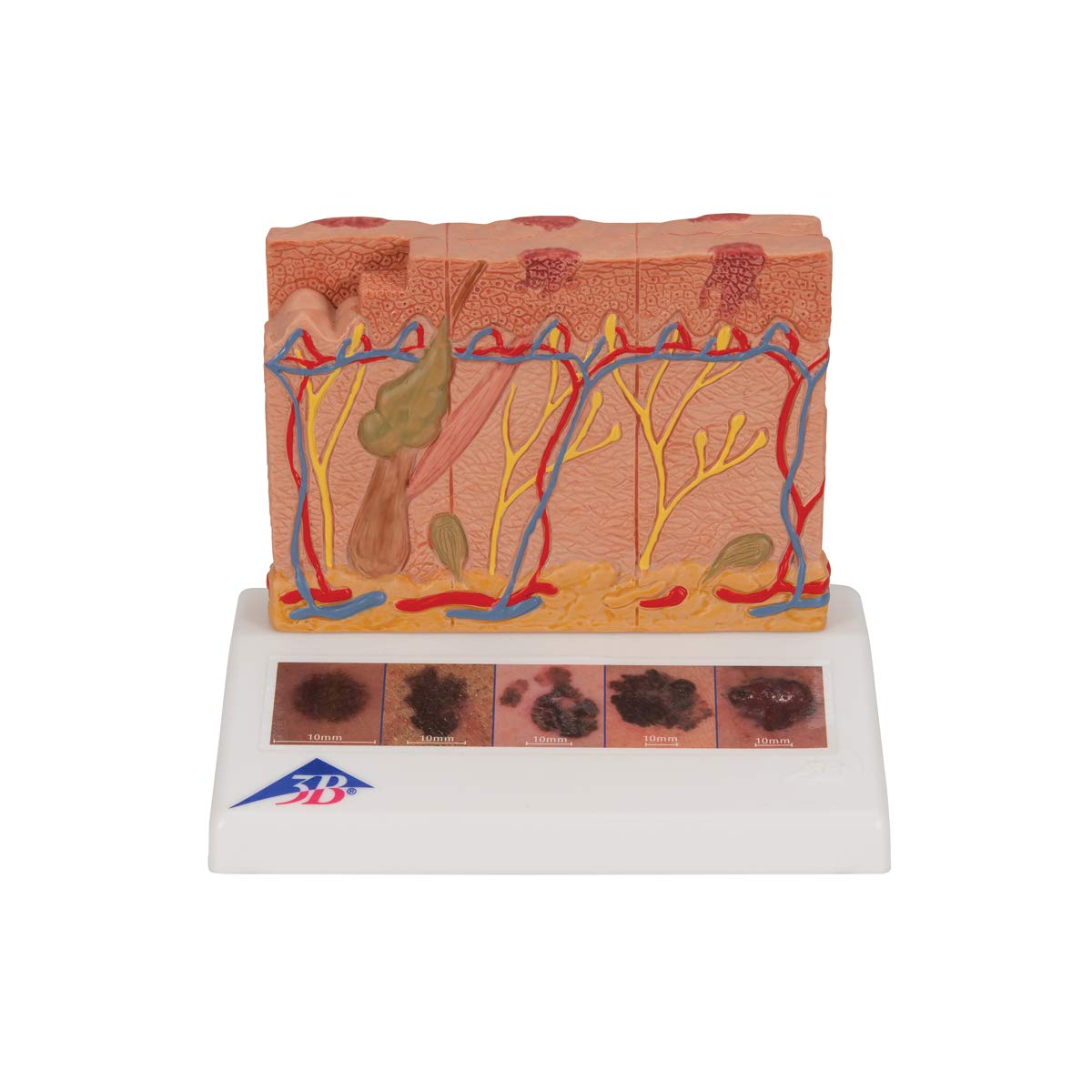 3B Scientific Menschliche Anatomie - Hautkrebs-Modell + kostenlose Anatomie App - 3B Smart Anatomy, J15