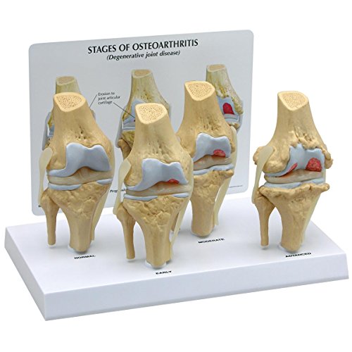 GPI Anatomicals 1100 Osteo-Kniemodellset 4 verschiedener Stadien