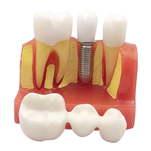 Zahnimplantatanalyse Krone Brücke Modell 4 Mal Zahnimplantat Zähne Modell mit abnehmbaren Kronen Zahnärzte Patienten Implantat Zähne Modell