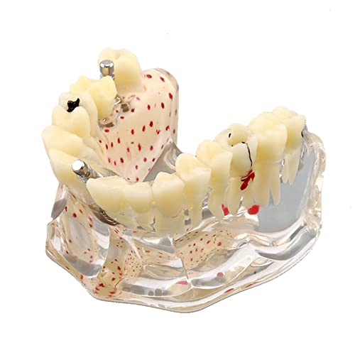 Dental Upper Implantate Modell - Upper Overdenture Restauration Modell - mit überlegenen Zähnen Demo Transparent Vision, Soft Gum, Implant Nagel, für Bildung und Studium Modell Werkzeug (B)