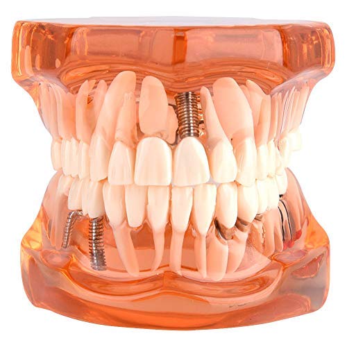 Jadeshay Zahn Modell - entfernbares Zahn-Implantat Lehrmodell Zahnarzt Demonstration Werkzeug für Zahn Schulstudien-Unterricht, orange