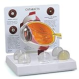 SLRMKK Augapfel Linsenkrankheit Modell Glaukom Katarakt Pathologie Wafer Demonstration Modell Augapfel Modell