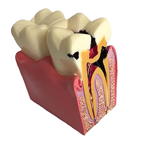 Sharplace 1 Stück Karies Vergleichsstudie Zahn-Modell Zähne Lehr-Studie-Modell Mündliche Abnehmbare -Pädagogisches Modell