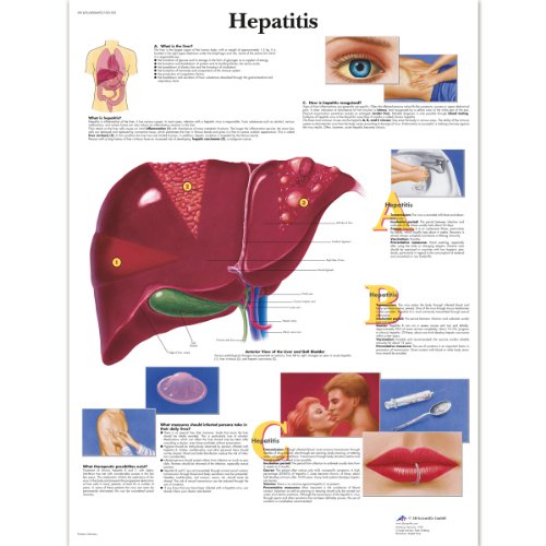 3B Scientific Human Anatomy- Hepatitis-Diagramm, laminierte Version
