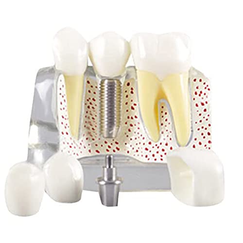 QWAMBVZE Zahn-Demonstrations-Modell-Implantat-abnehmbare Analyse-Kronen-Brücke für Arzt-Patient-Kommunikation, transparent