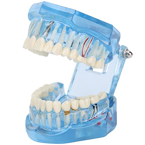 Zähne Modell,Lehre Zähne Modell,Zahnzähne Modell Acryl Blau Transparent Lehrdemonstration Simulation Zähne Modell Demonstration