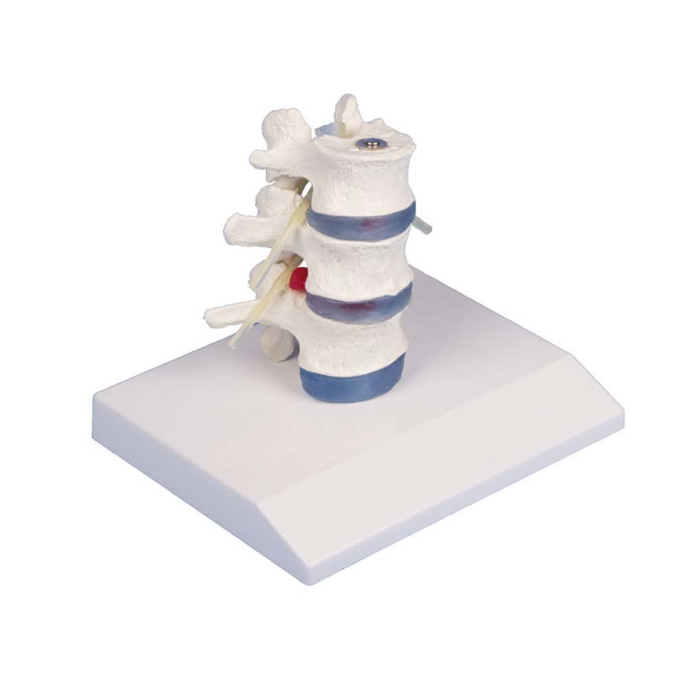 Anatomie Modell Lendenwirbel mit Bandscheibenvorfall, zerlegbar, Stativ