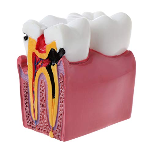 6 Karies Vergleichs Anatomie Zähne Modell Für Anatomie Labor Menschliches Körpermodell Für Kinder