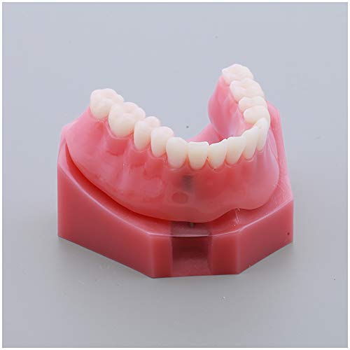 FHUILI Zähne Modell für Bildung - Reparatur Implantat Zähne Modell - Arzt-Patient-Kommunikation Red Gebiss Modell Simulation Oral Zahn-Zahn-Vorführmodell,A
