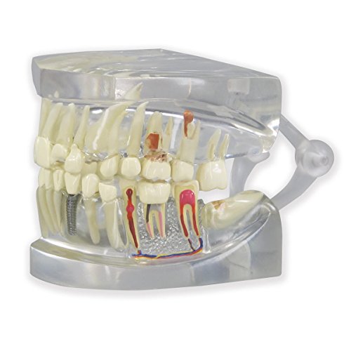 GPI Anatomicals 2861 Gebiss Modell durchsichtig mit Zähnen