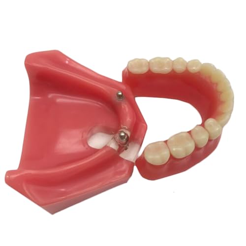 Dental Typodont Zähne Modell, Dental Restauration Modell mit 2 Implantaten, für Zahnarzt Lehre Forschung Dental Labor