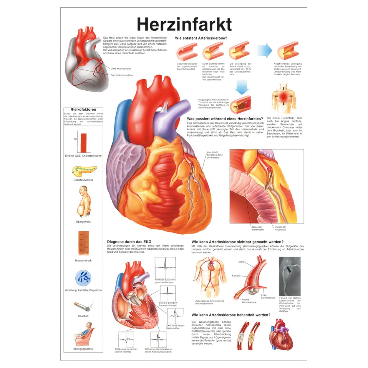 Rüdiger Herzinfarkt Poster Anatomie 70x50 cm medizinische Lehrmittel