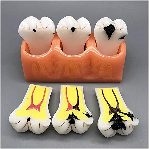 FHUILI 4X große Zähne Modell - Karies Pathologische Karies Modell - Dental Zähne Modell Shallow Karies Tiefe Karies Patient Demo Teaching Modell,A