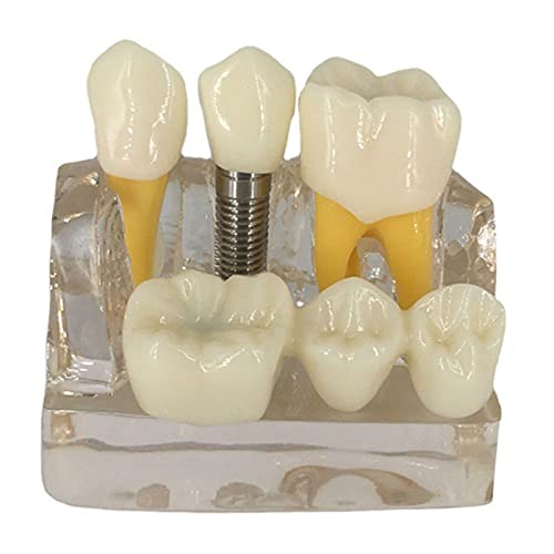 Zahnimplantatanalyse Krone Brücke Modell 4 Mal Zahnimplantat Zähne Modell mit abnehmbaren Kronen Zahnärzte Patienten Implantat Zähne Modell