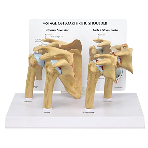 GPI Anatomicals 1800 Schuler Modell, Arthrose 4 Stadien