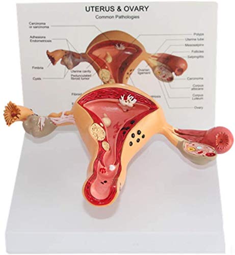 Bildungsmodell anatomisches Modell des weiblichen Uterus - anatomisches Modell der Ovarian Läsion pathologischer inneren Geschlechtsorgane zu medizinischen Ausbildung gynäkologischen