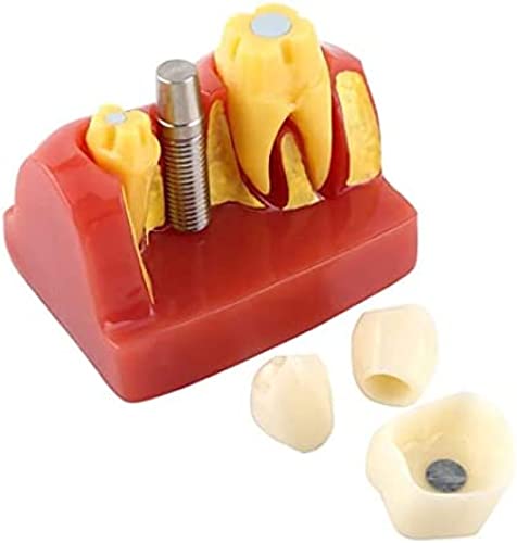 Zahnmodell, Zahnimplantatanalyse, Kronenbrückenmodell, herausnehmbares orales Lehrmodell für kieferorthopädische Implantatrestaurierung, Zahnmodell für den Zahnarztstudienunterricht