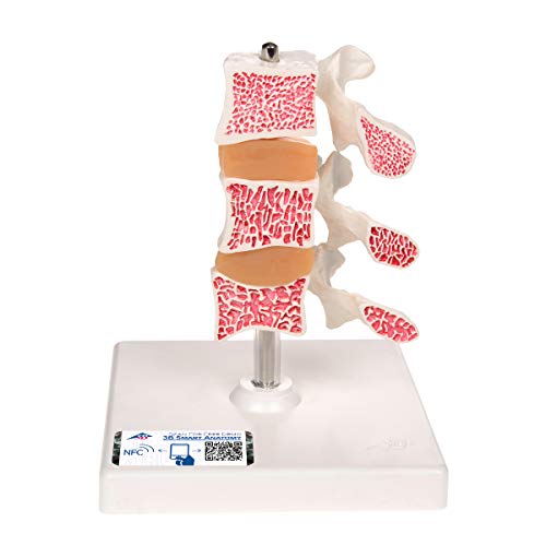 3B Scientific menschliche Anatomie - Osteoporose Modell mit 3 Lendenwirbeln, auf Stativ - 3B Smart Anatomy