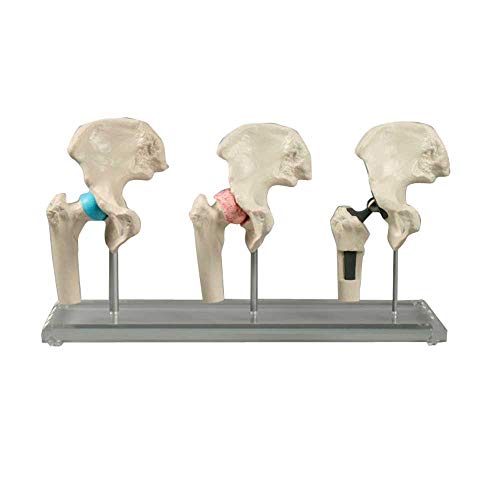 Erler Zimmer Hüft-Implantat-Modelle Anatomie Modell Hüftmodell verkleinert, gesund/krank/Implantat, 3St