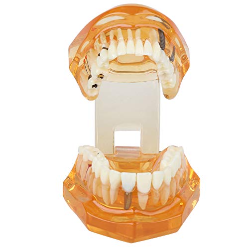 Standard-Zahnmodell, herausnehmbare zahnärztliche Unterrichtsmaterialien für Kinder, Standard-Typodont-Demonstrationszahnmodell für Erwachsene